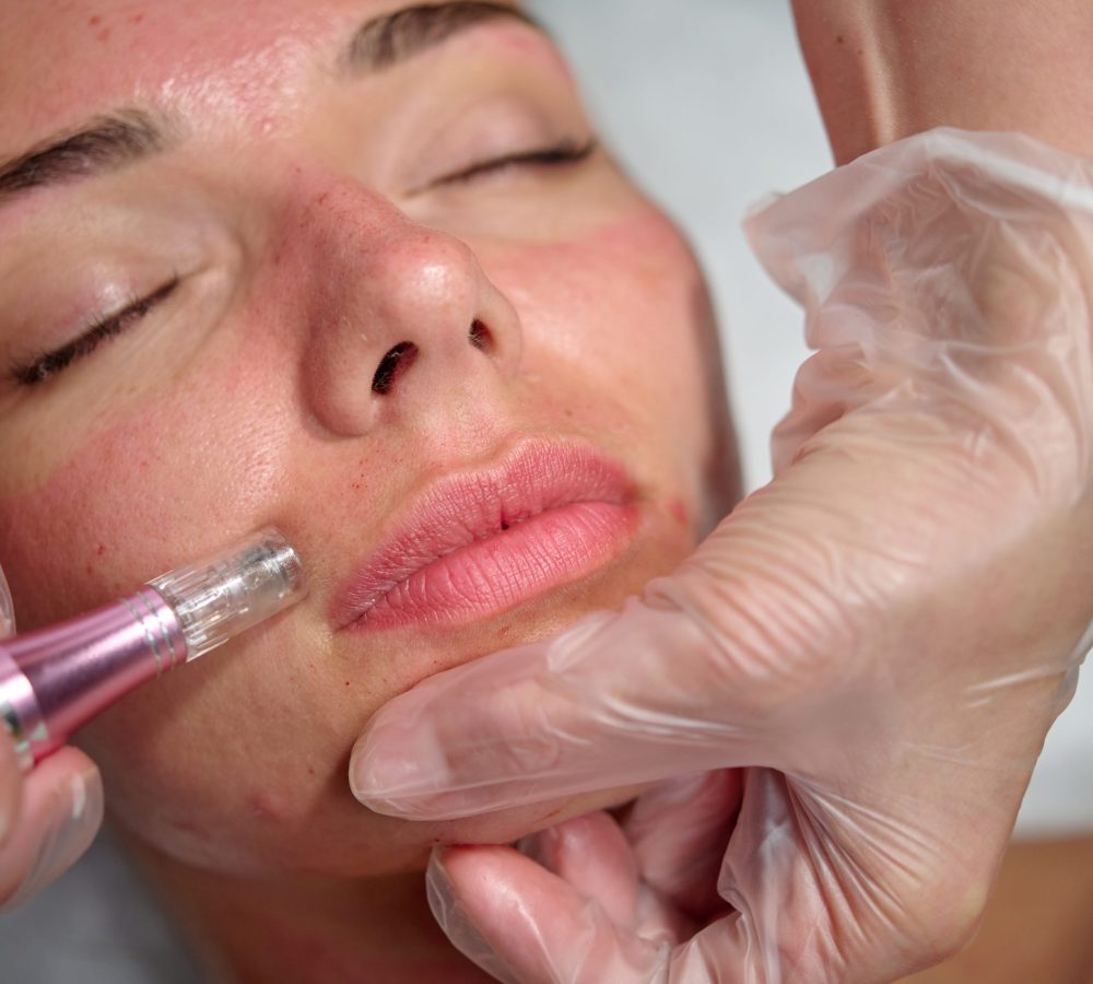Cosmetician,Makes,Microneedling,,Care,To,The,Patient,Using,Dermapen Cosmetician,Makes,Microneedling,,Care,To,The,Patient,Using,Dermapen